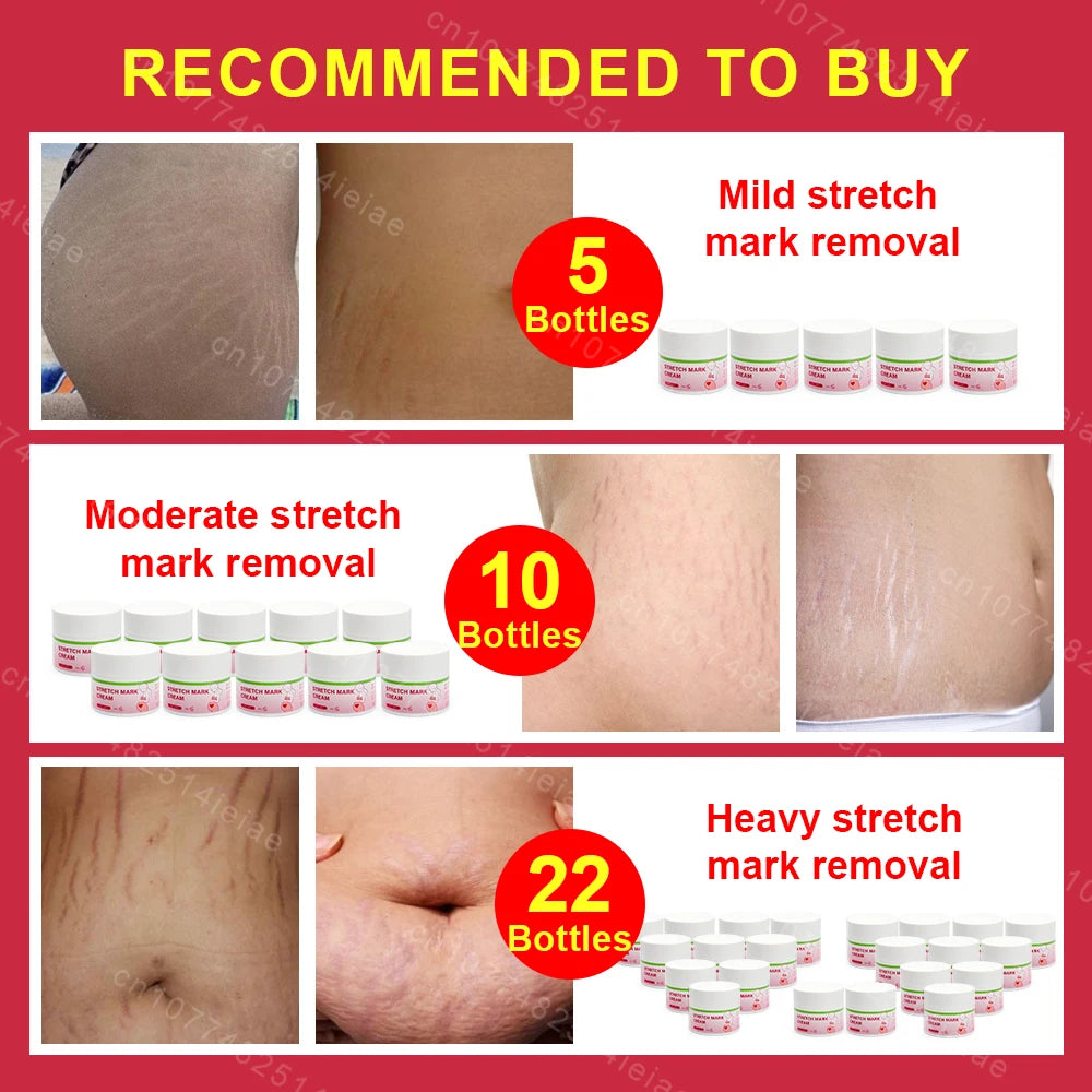 Pregnancy Mark Removal Cream