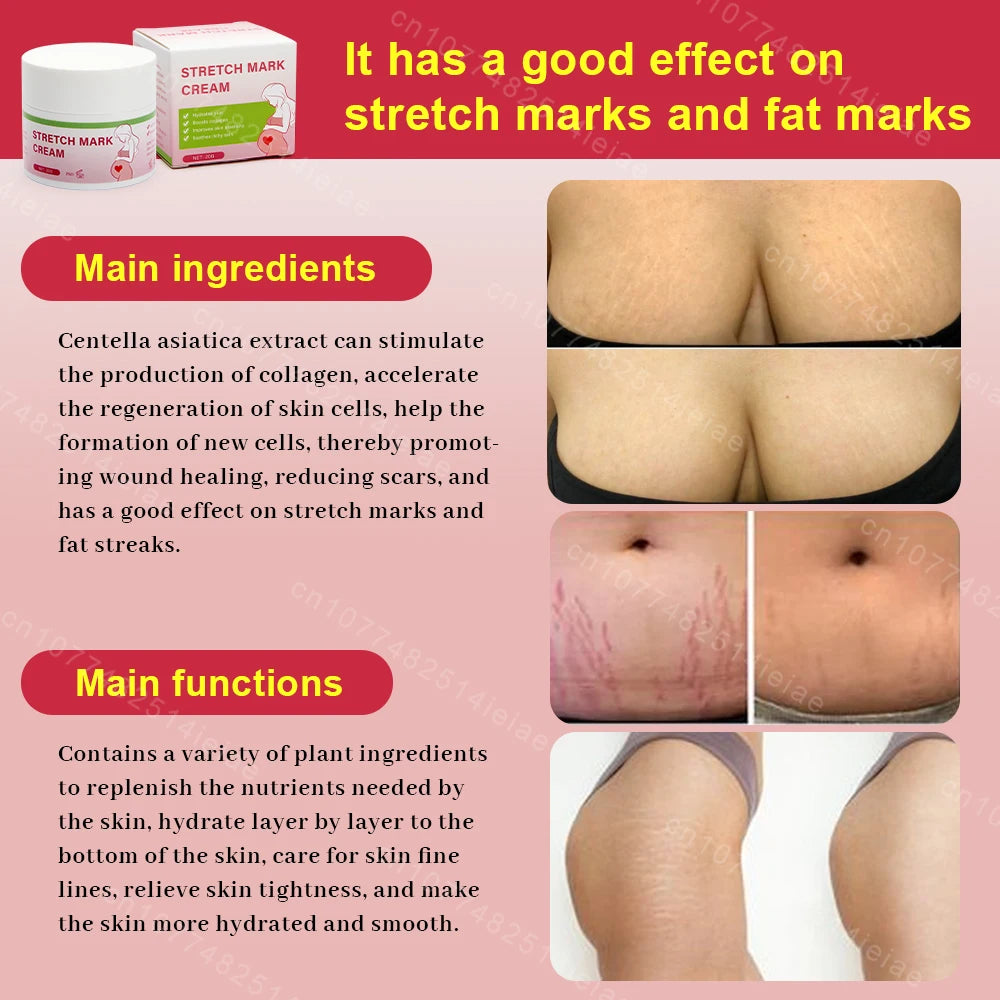 Pregnancy Mark Removal Cream