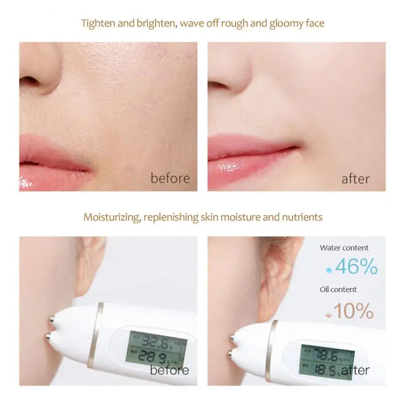 Acne Remover Whitening Face Serum