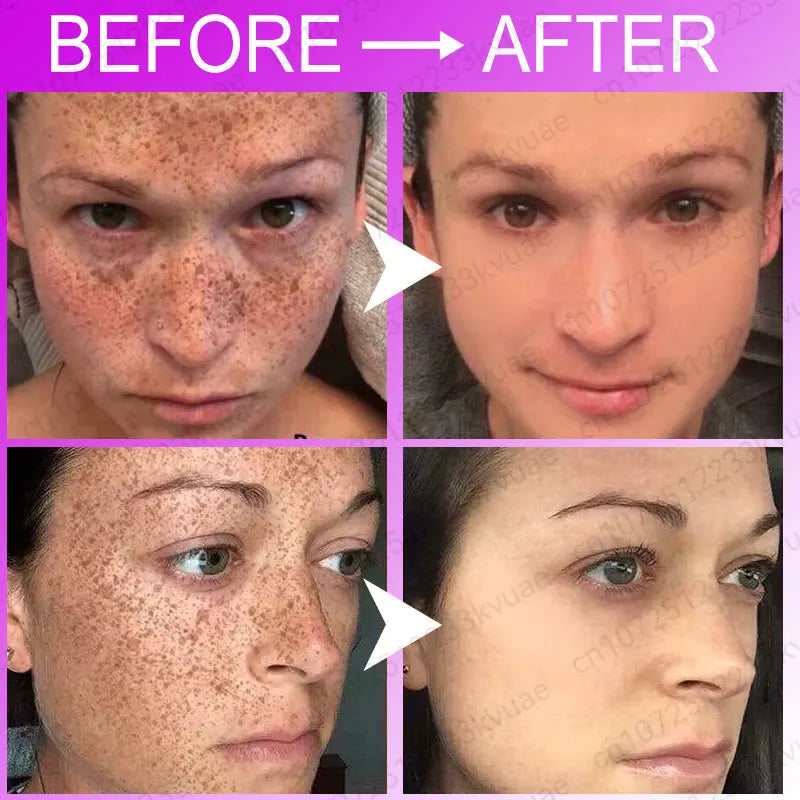 Anti-freckle serum restores skin collagen Remove