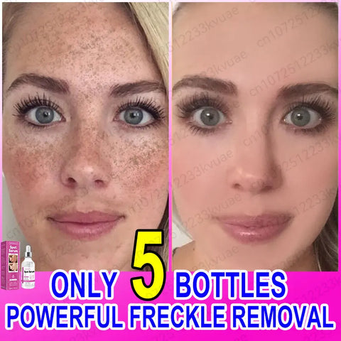 Anti-freckle serum restores skin collagen Remove