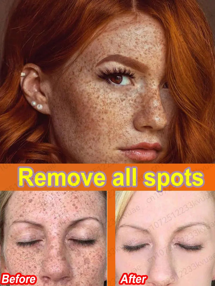 Anti-freckle serum restores skin collagen Remove